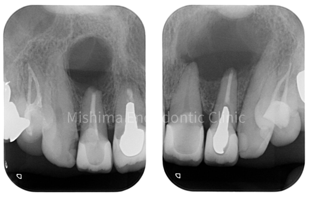 静岡の根管治療・歯内療法｜みしま歯内治療院